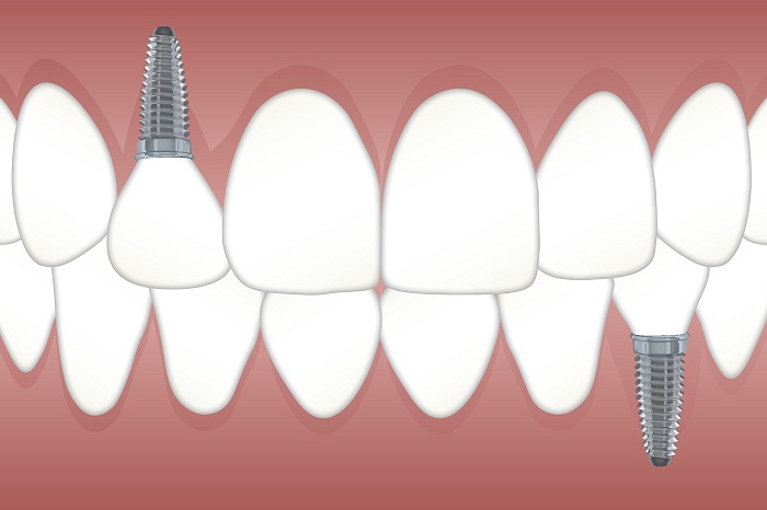 Zubné implantáty a ich starostlivosť